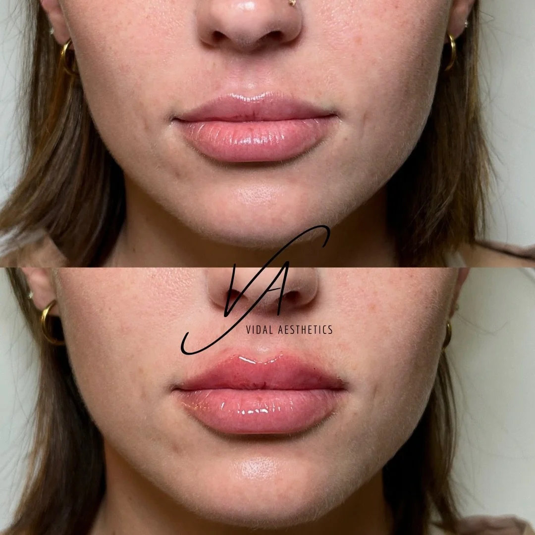 A subtle refresh makes all the difference. ✨
This lip enhancement was designed to restore shape, refine symmetry, and enhance natural volume&mdash;never overdone, always intentional. The goal is lips that look effortlessly balanced and beautifully yo