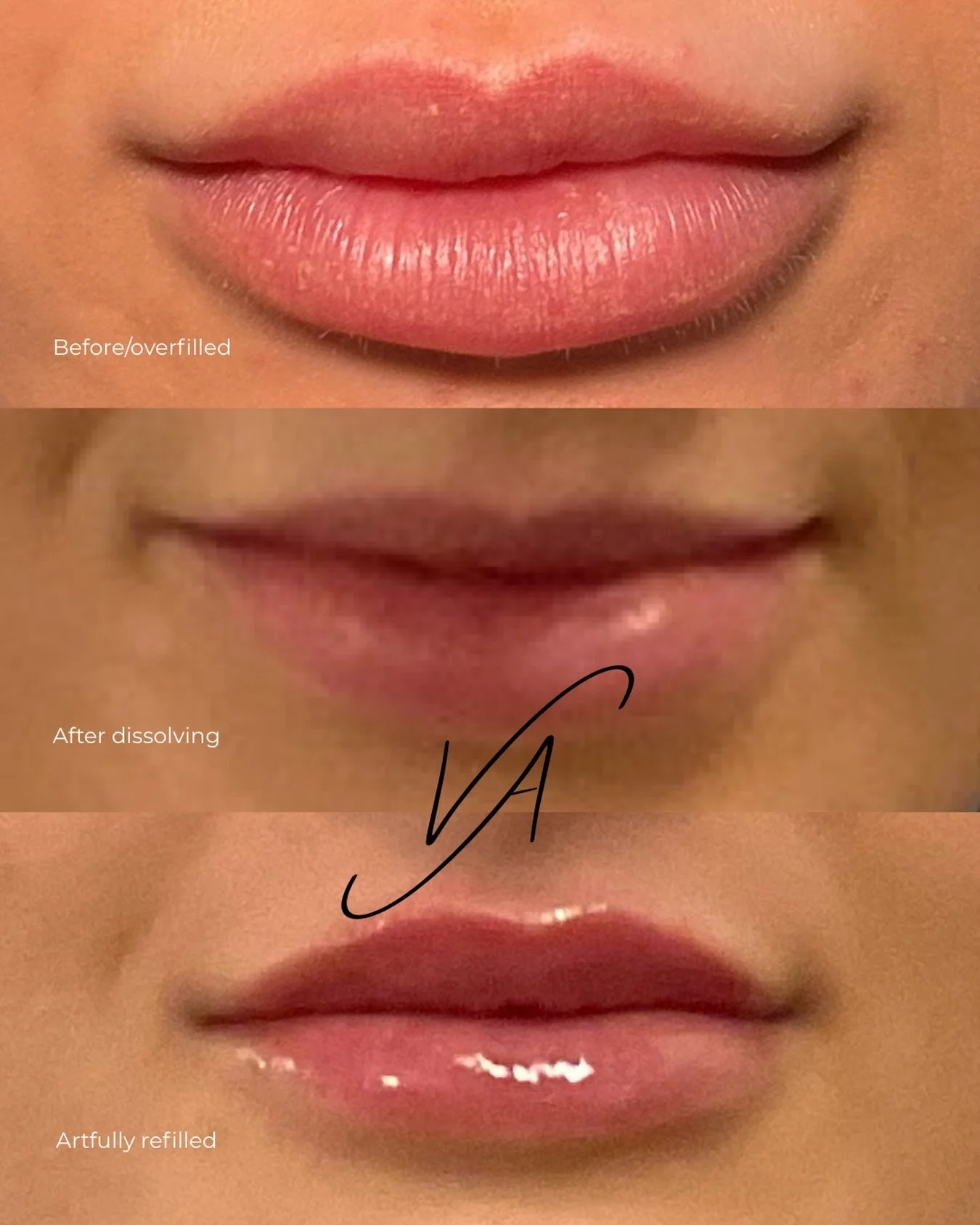 True lip beauty starts with a healthy foundation. ✨

This lip rehab journey began by carefully dissolving misplaced, overdone filler that created uneven, lumpy texture. 

After allowing time for the tissue to fully heal, the lips were thoughtfully an