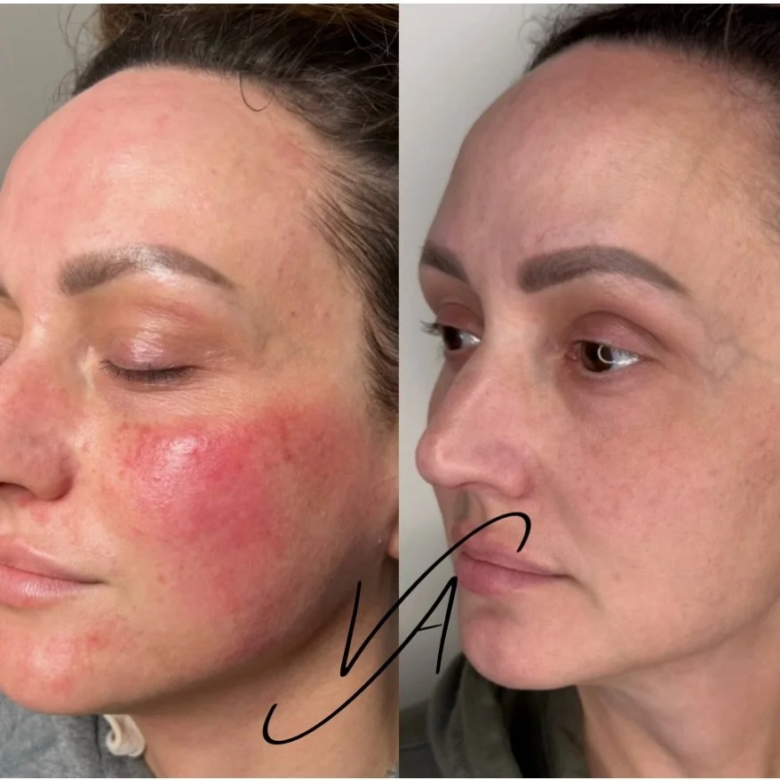 Rosacea Awareness Month 🤍

Rosacea requires a thoughtful, customized approach,because no two skins present the same. This transformation highlights what&rsquo;s possible when inflammation is properly addressed and the skin barrier is supported every