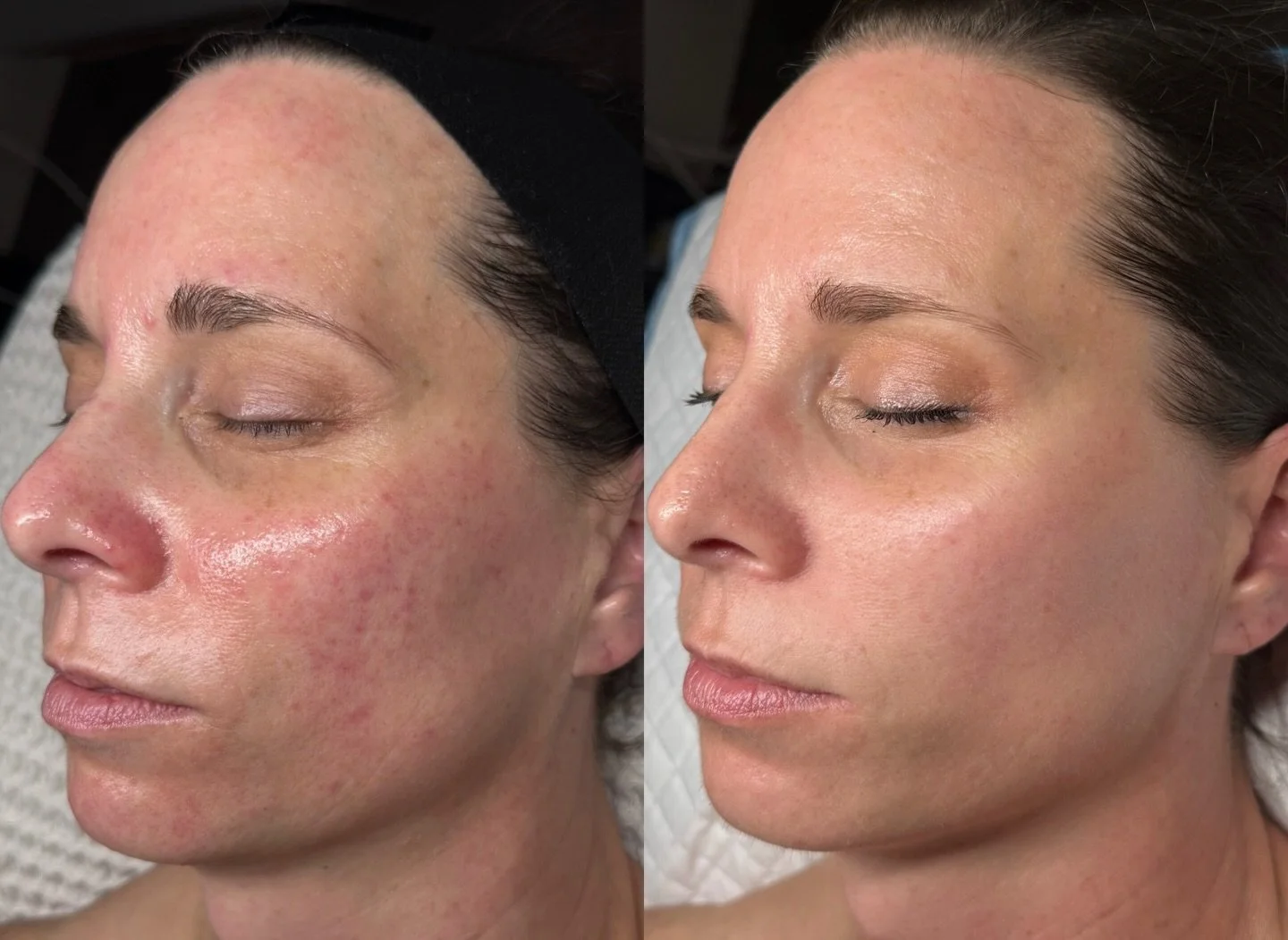 Skin is never &ldquo;one size fits all&rdquo;&mdash;and it&rsquo;s definitely not static. It&rsquo;s something you read, adjust to, and refine over time.

With this longtime client, we hit a point where inflammation and redness started to creep back 