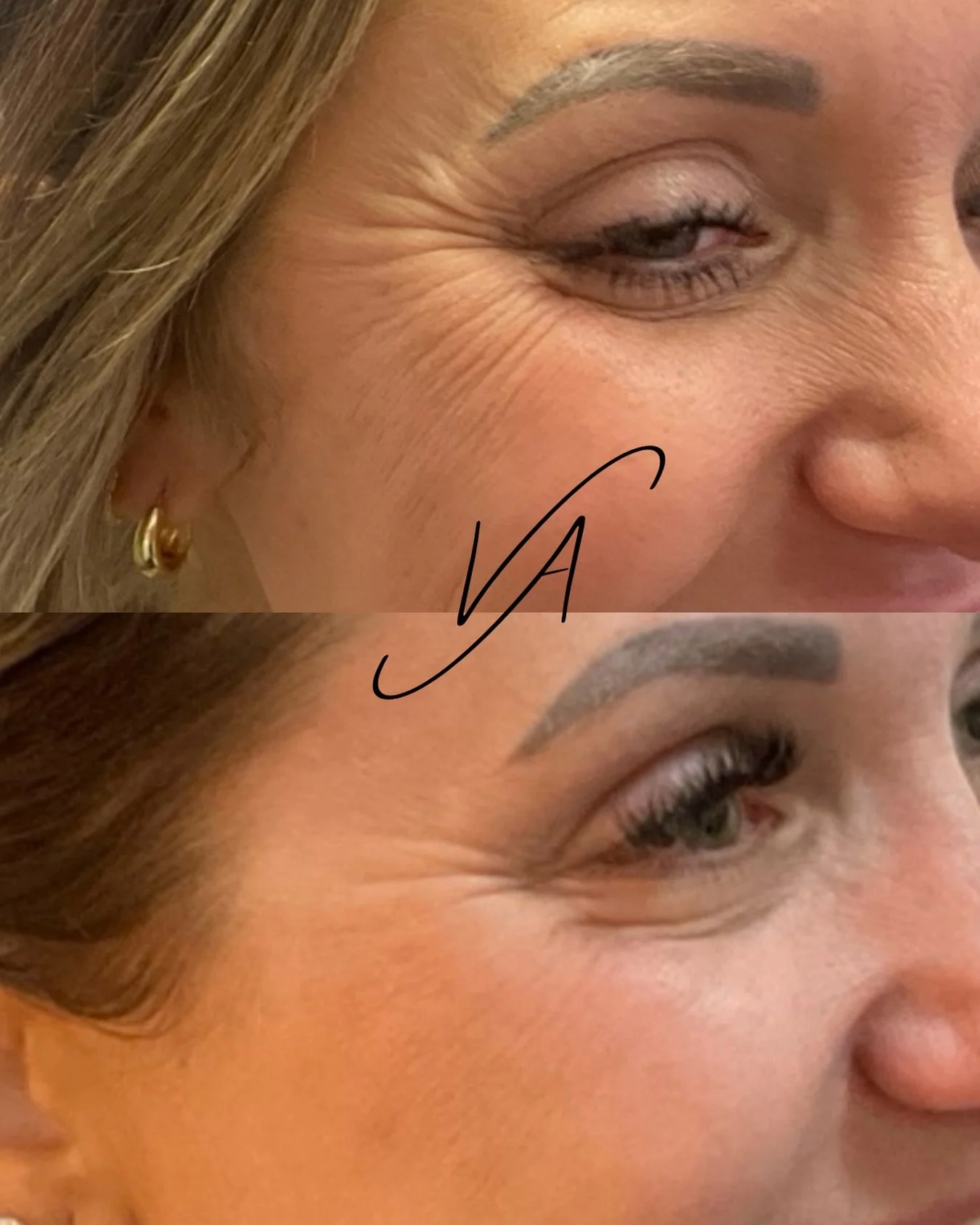 Botox should never make you look like a different person ✨
The goal is softening lines, improving skin texture, and helping you look more refreshed and rested &mdash; not frozen or overdone. The best results still look natural, balanced, and complete