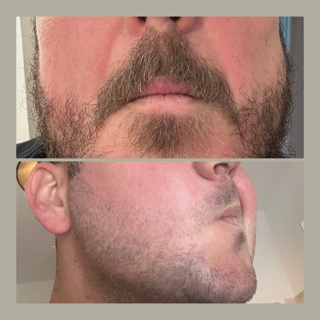 Comparison of a man's face before and after facial hair removal, showing a bearded face in the top image and clean-shaven face in the bottom image.