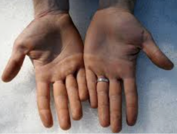 Two hands held with palms up, one with a silver ring on the ring finger.