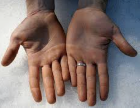 Close-up of two hands showing palms, with one hand wearing a wedding band.