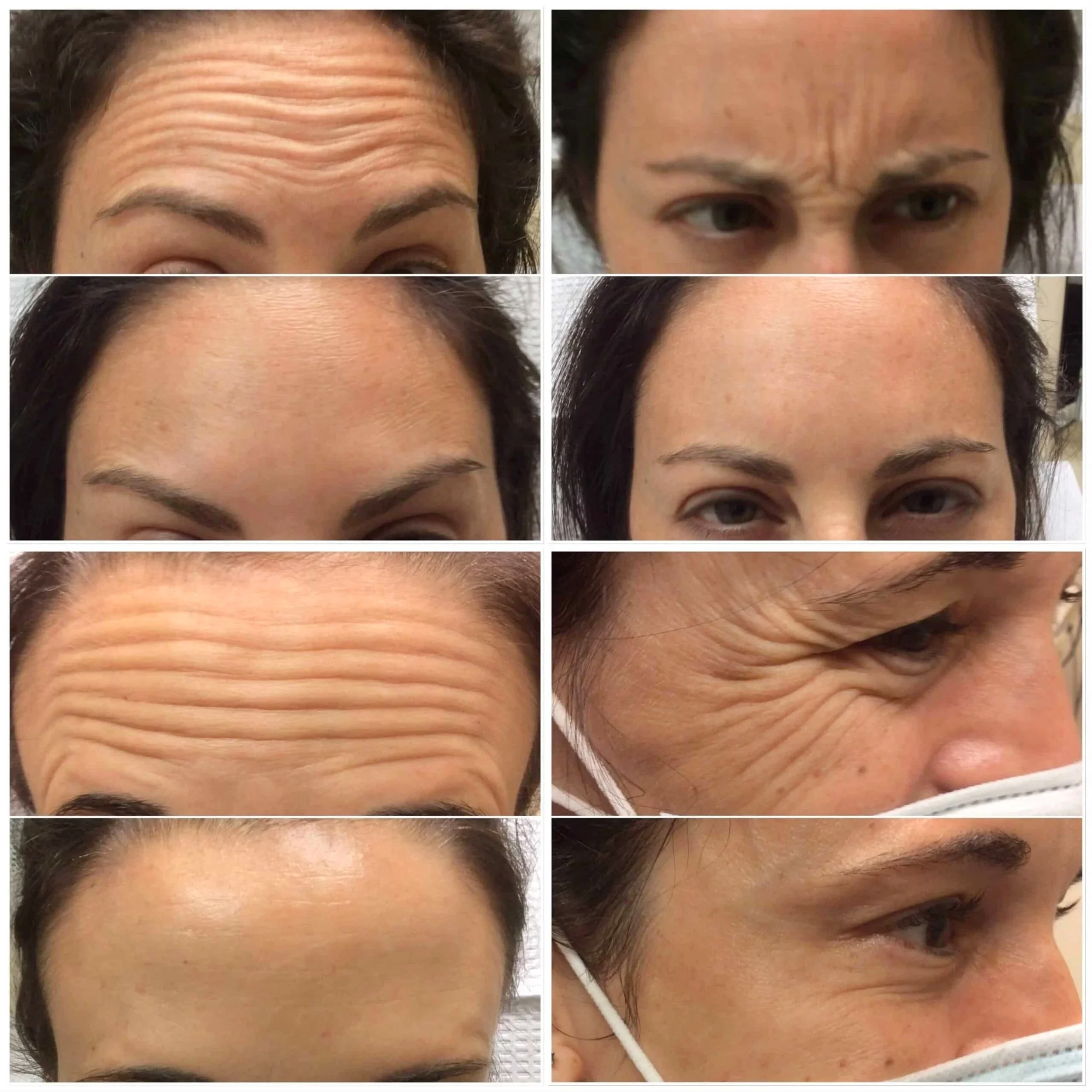 Botox+Image.jpg
