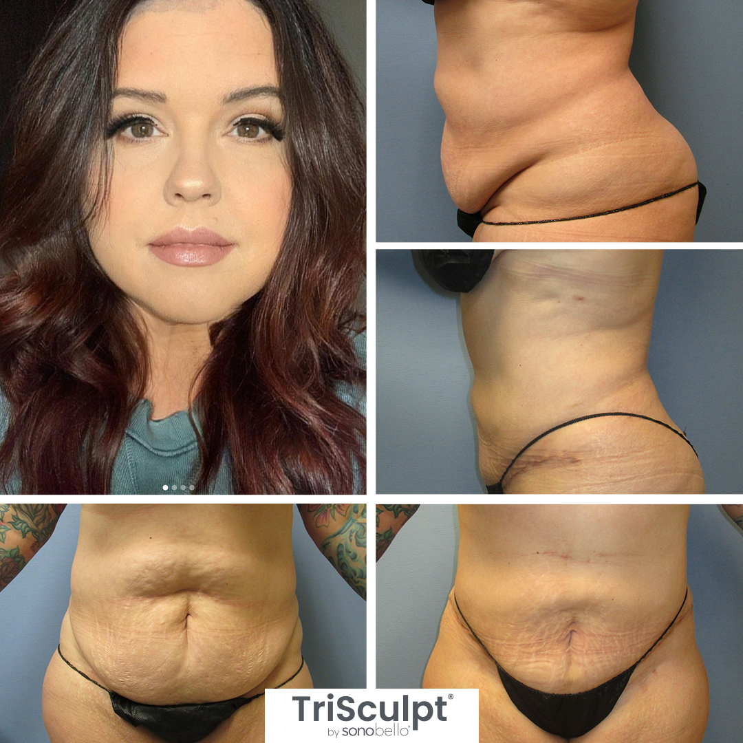 Sono Bello collage showing a woman before and after a body contouring procedure, focusing on her abdominal area, with a portrait of her face on the left.