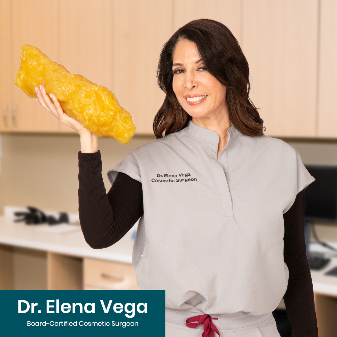 Female Sono Bello professional surgeon holding a large, yellow, piece of 5 pounds of fat in a clinical setting.