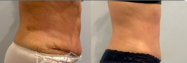 Side-by-side comparison of a person's abdomen before and after weight loss or body transformation, showing significant reduction in abdominal size and skin changes.