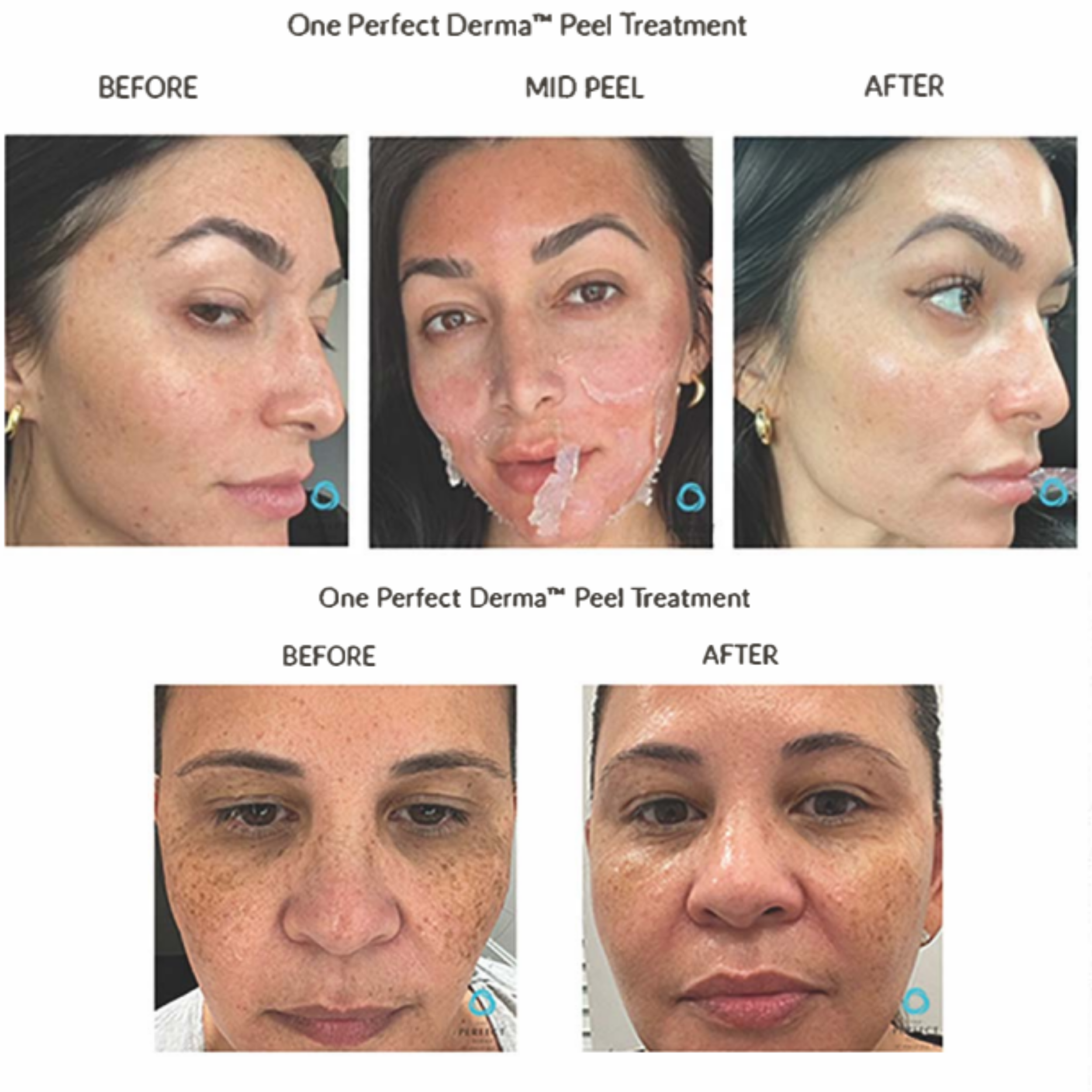Comparison images showing the before and after results of the One Perfect Derma Peel Treatment on two women. The first woman has acne scars and pigmentation in the before picture, and her skin appears clearer and more even in the after picture. The second woman has dark spots and uneven skin tone in the before picture, with a noticeable reduction in spots and improved skin tone in the after picture.