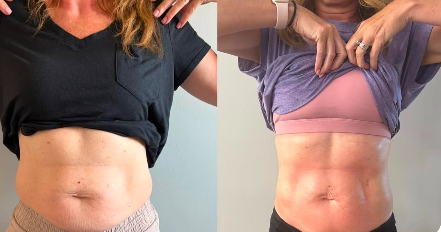 cavitation