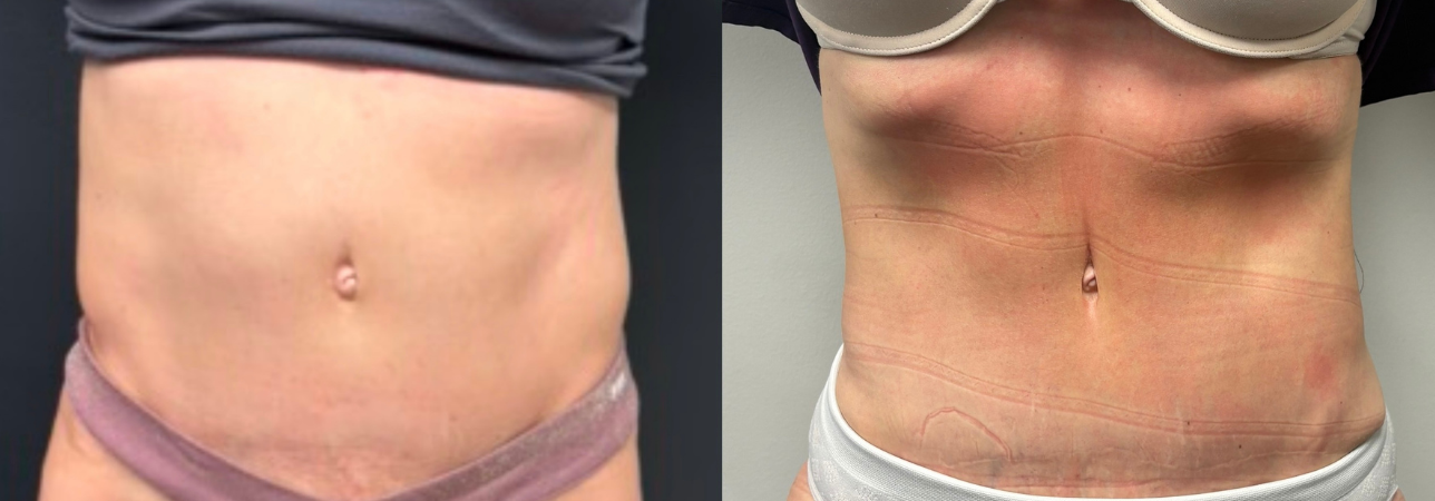 Comparison of a person's abdominal area before and after a cosmetic procedure, showing reduced fat and improved skin tightness.