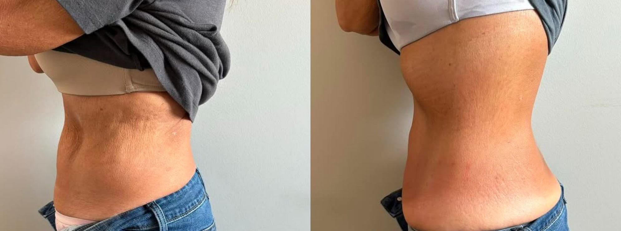 skin tightening