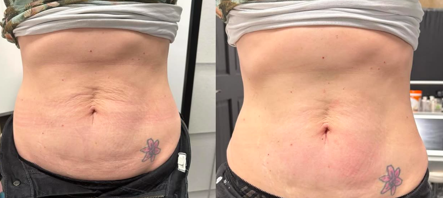 Comparison of a person's lower abdomen before and after treatment showing reduced skin laxity, with a tattoo of a flower near the waistline.