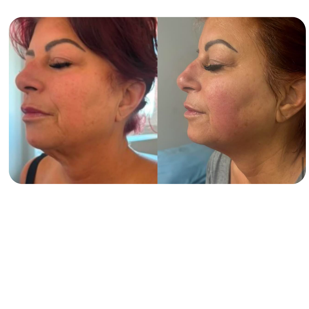 Side-by-side comparison of a woman's face before and after skincare or cosmetic treatment, showing improved skin texture and tone.
