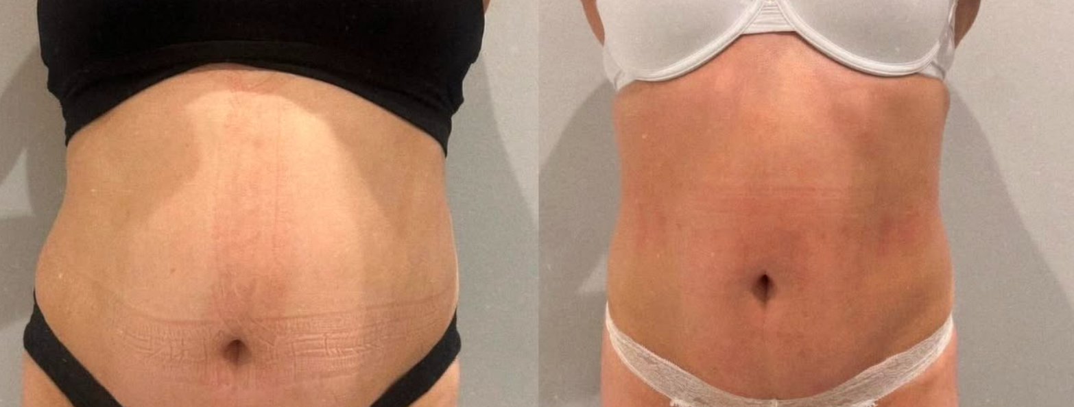 Comparison of a woman's abdomen before and after skin treatment, showing reduced wrinkles and improved skin texture in the after photo.