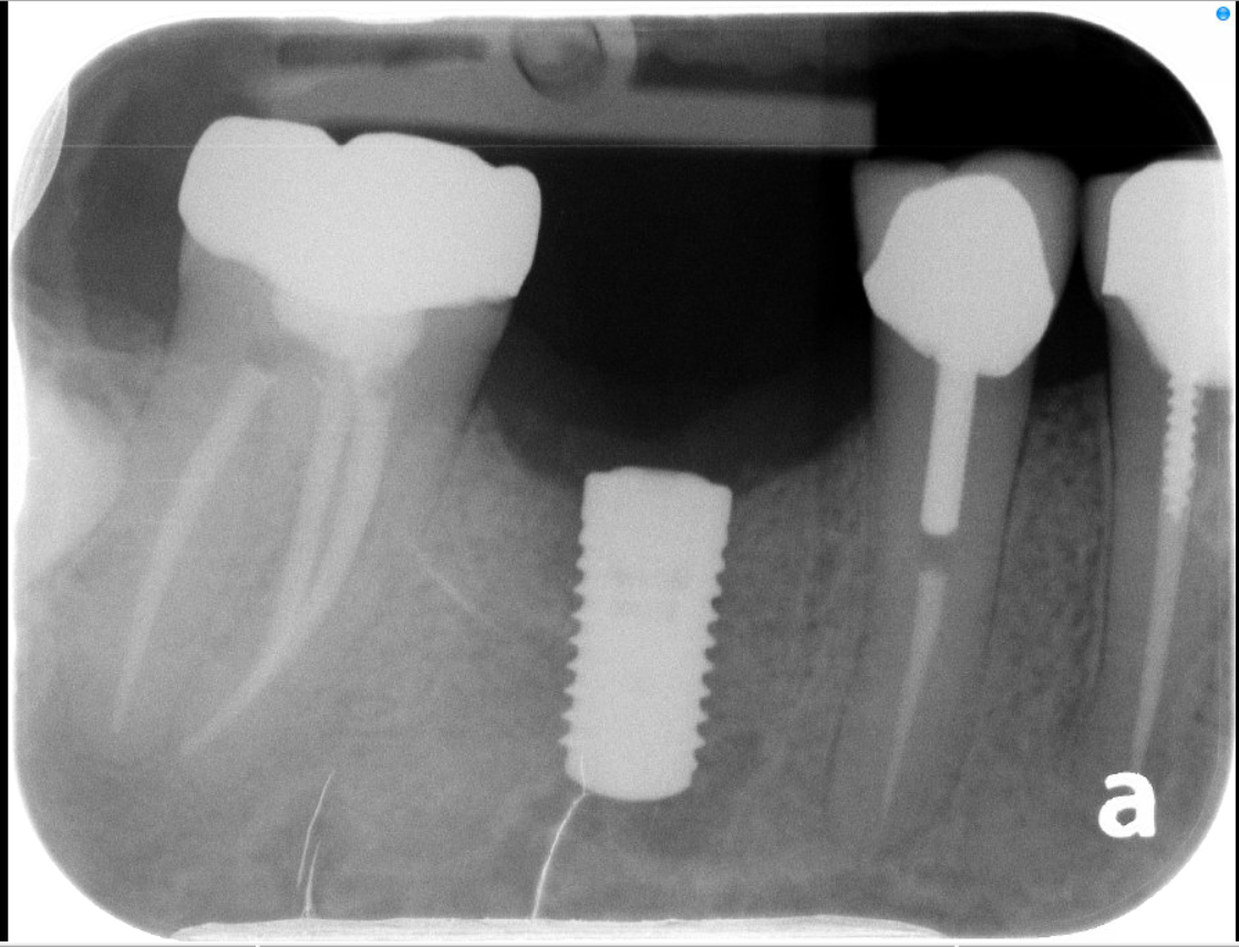 Implant placement.PNG