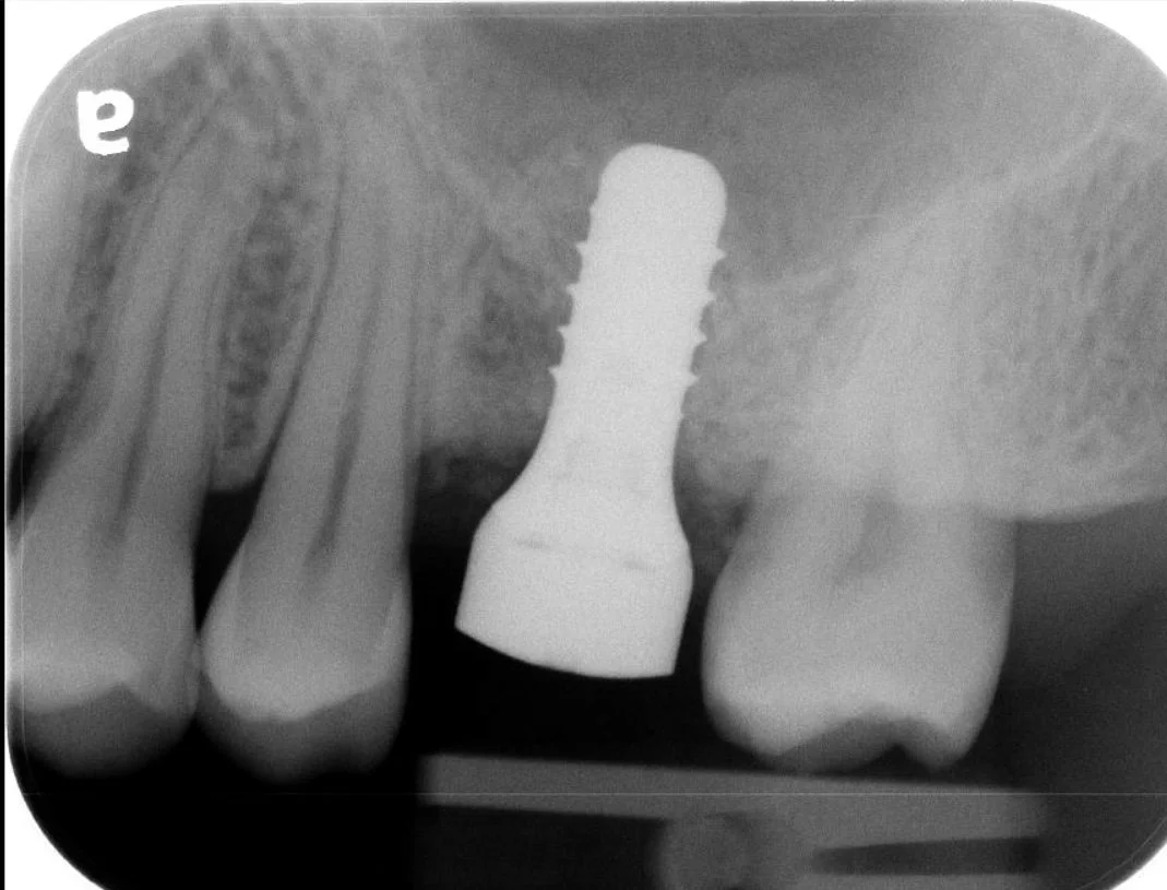 Post-op osteotome Weijian.jpg