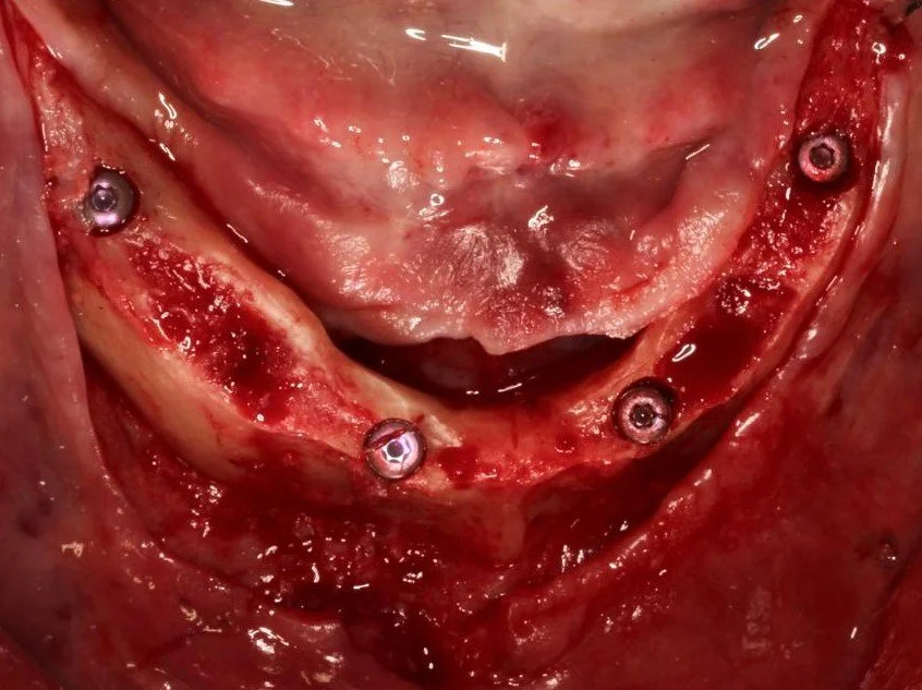 3. Implant placement.JPG