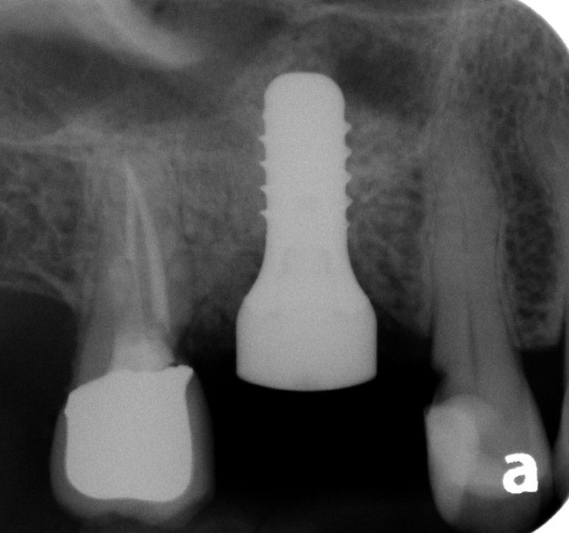 Post-op Michael Crawley.PNG