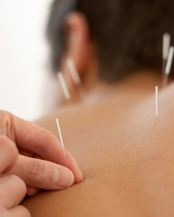 Acupuncture treatment with thin needles inserted into a person's back.