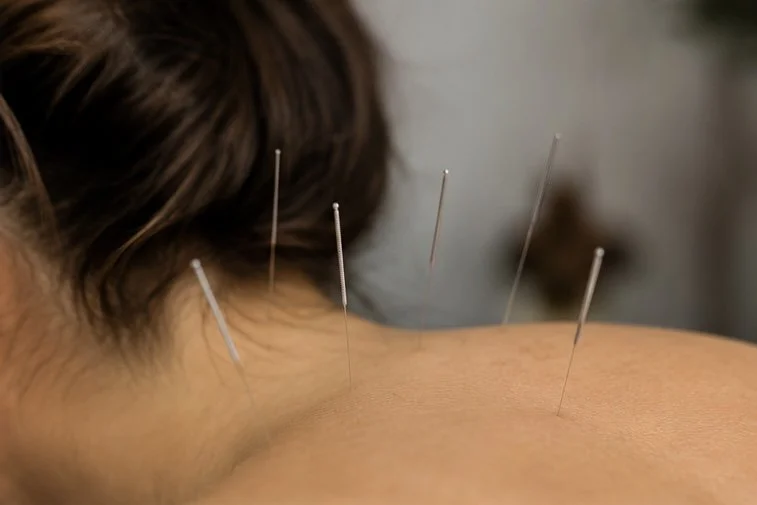 Person receiving acupuncture treatment with multiple acupuncture needles inserted into the back.