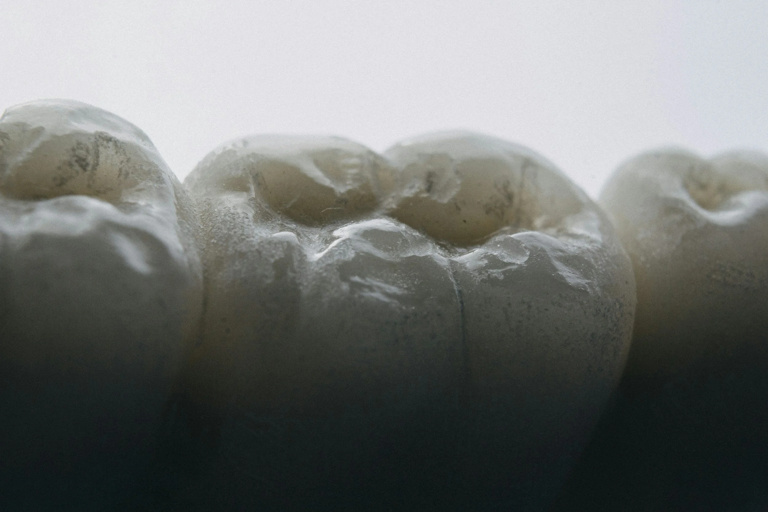 Cavities and Tooth Decay