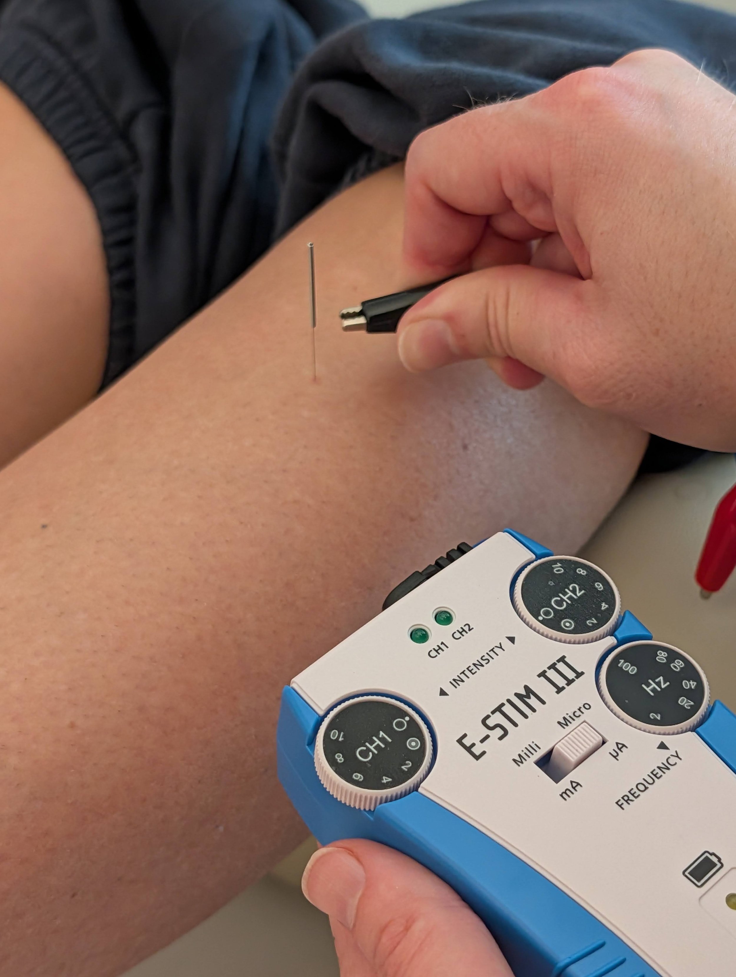 E-Stim