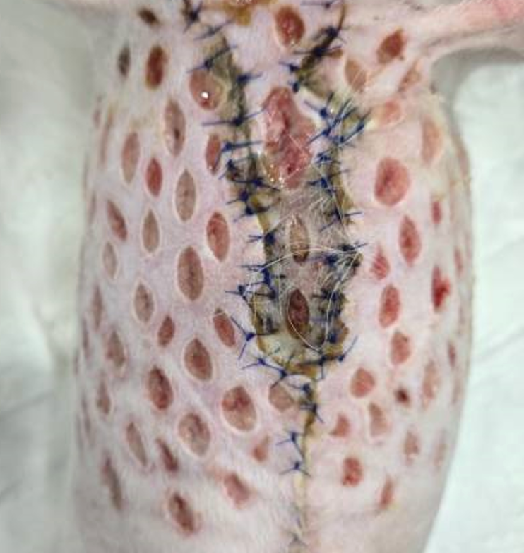 Post Mastectomy Necrosis