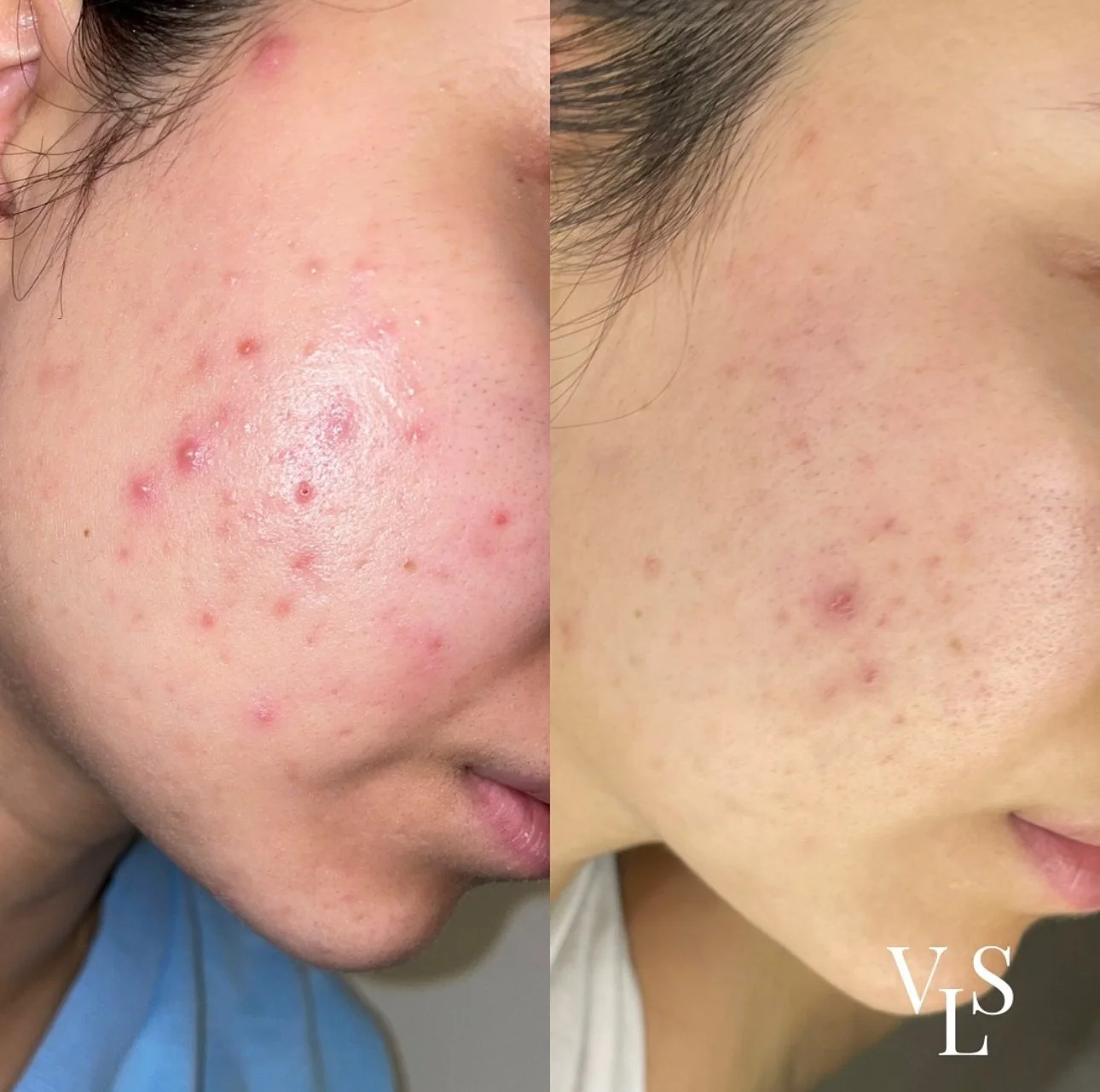 CHEMICAL PEEL BEFORE & AFTER