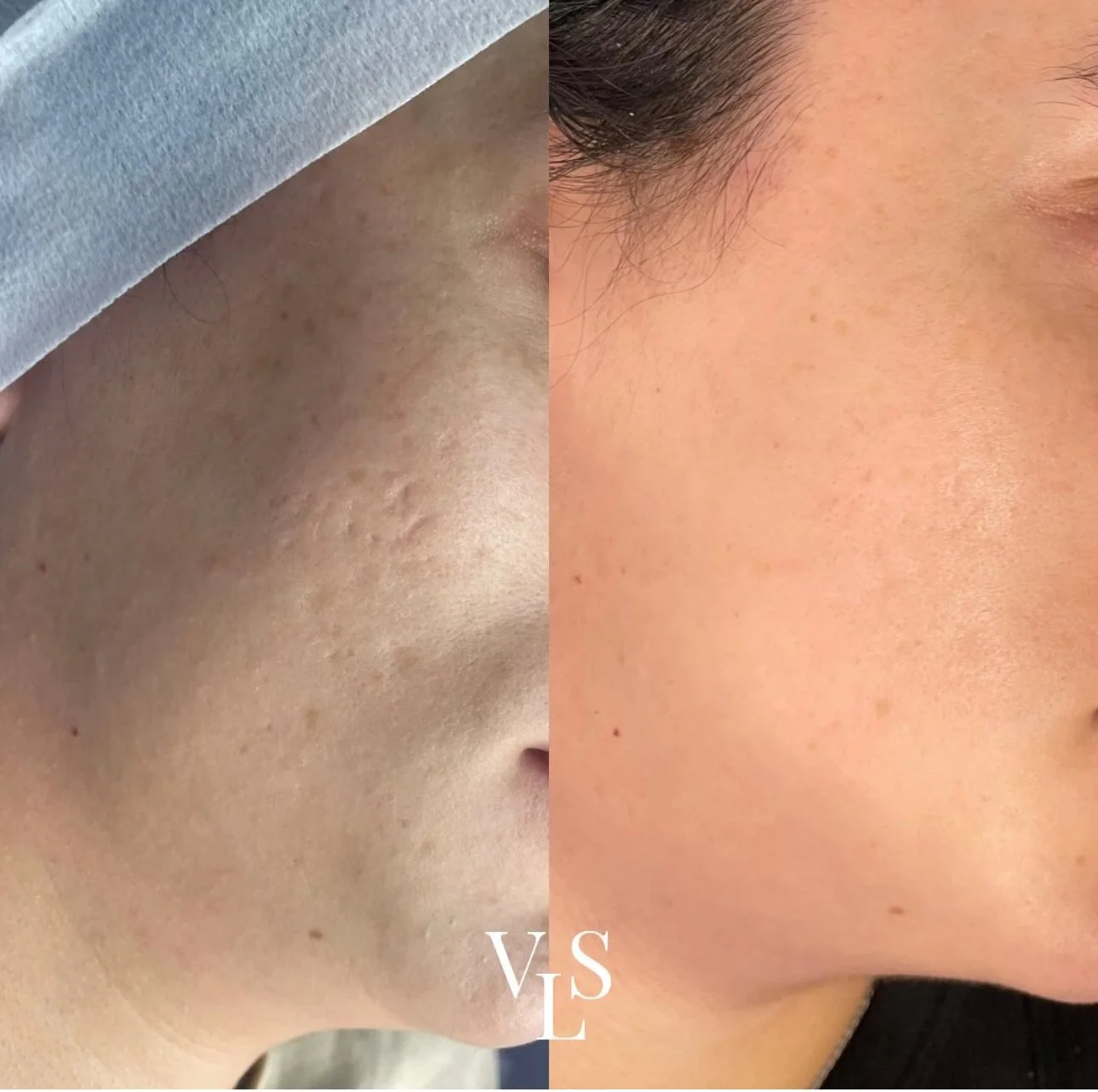 MICRONEEDLING BEFORE & AFTER