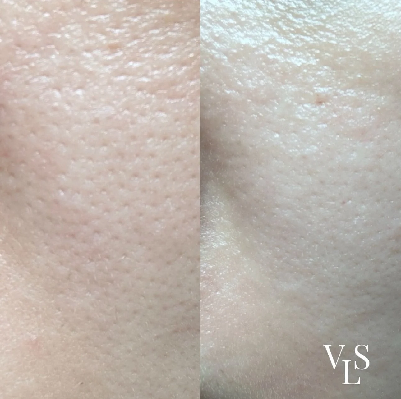MICRONEEDLING BEFORE & AFTER