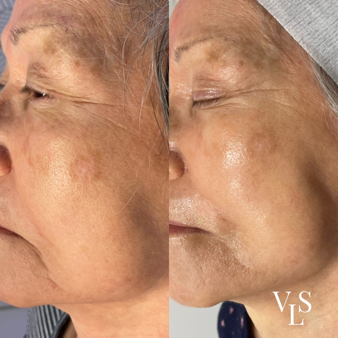 MICRONEEDLING BEFORE & AFTER