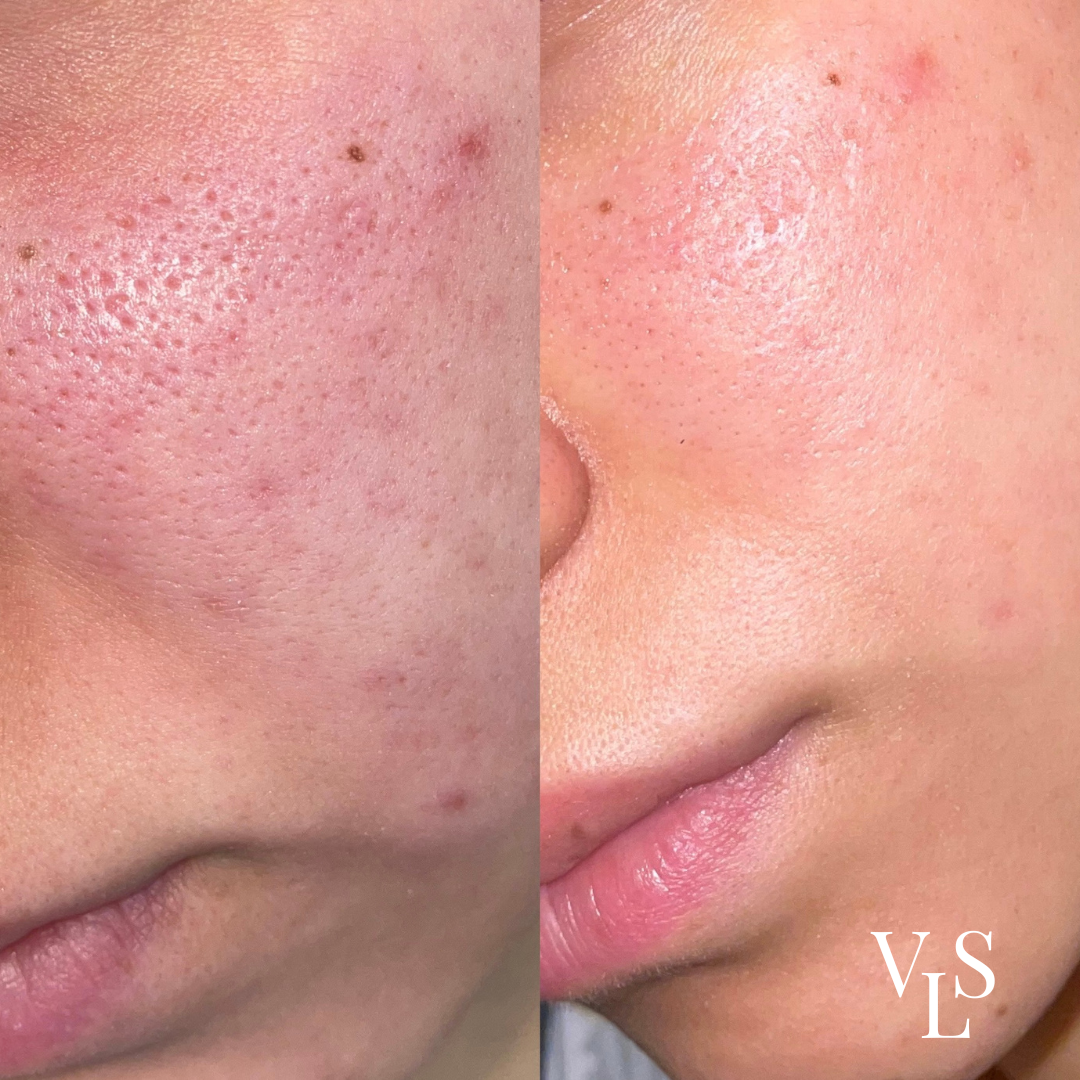 MICRONEEDLING BEFORE & AFTER