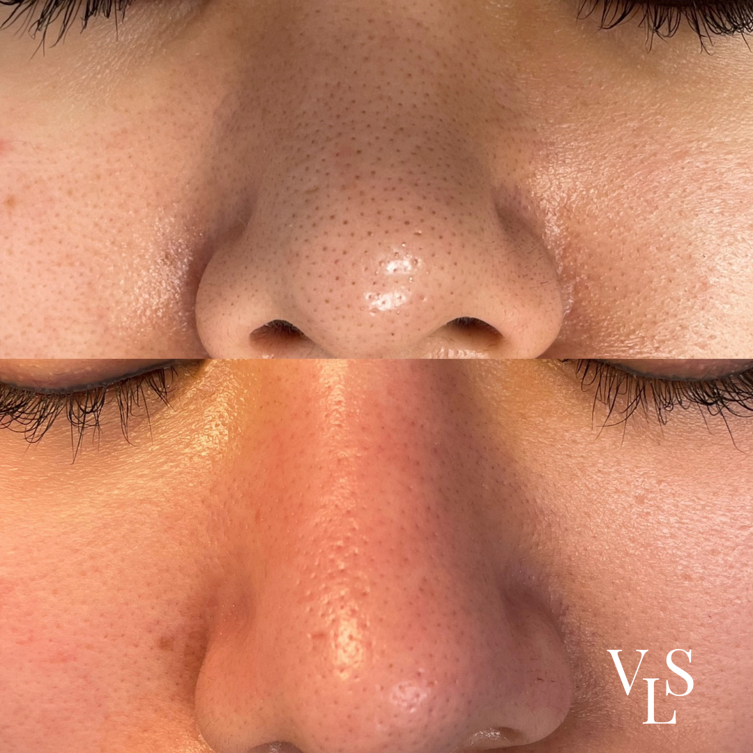 MICRODERMABRASION BEFORE & AFTER