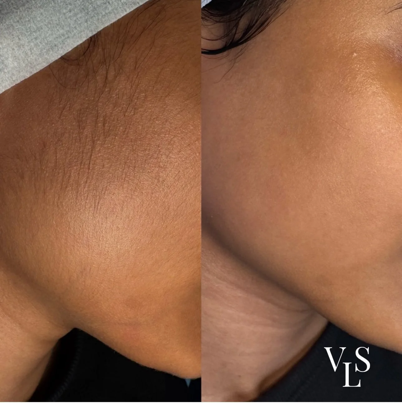 DERMAPLANING BEFORE & AFTER