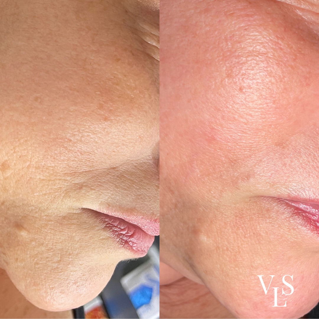 MICRONEEDLING BEFORE & AFTER