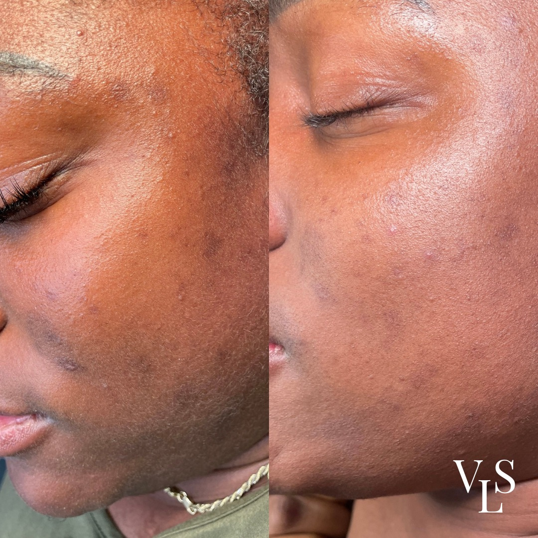 CHEMICAL PEEL BEFORE & AFTER