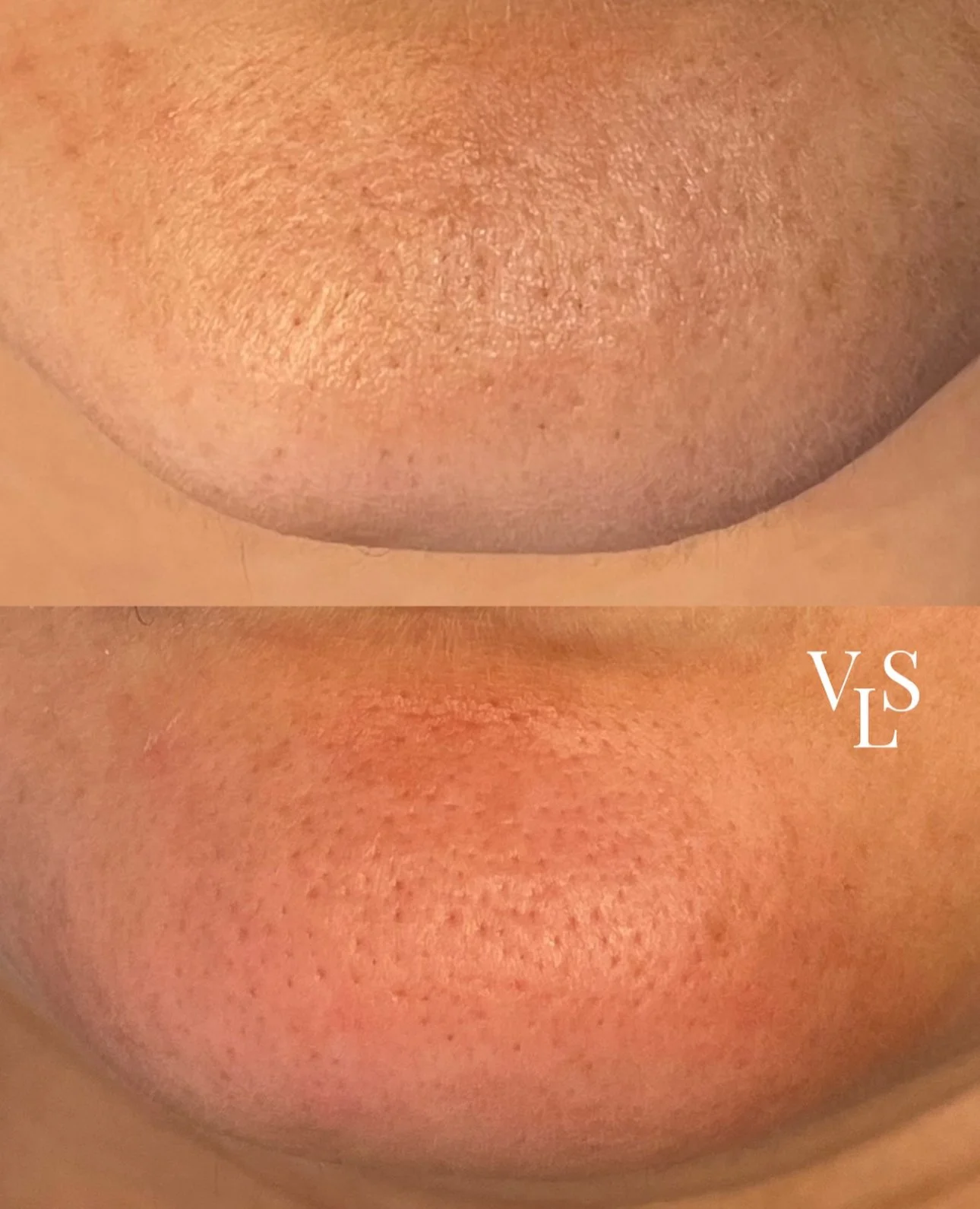 MICRODERMABRASION BEFORE & AFTER