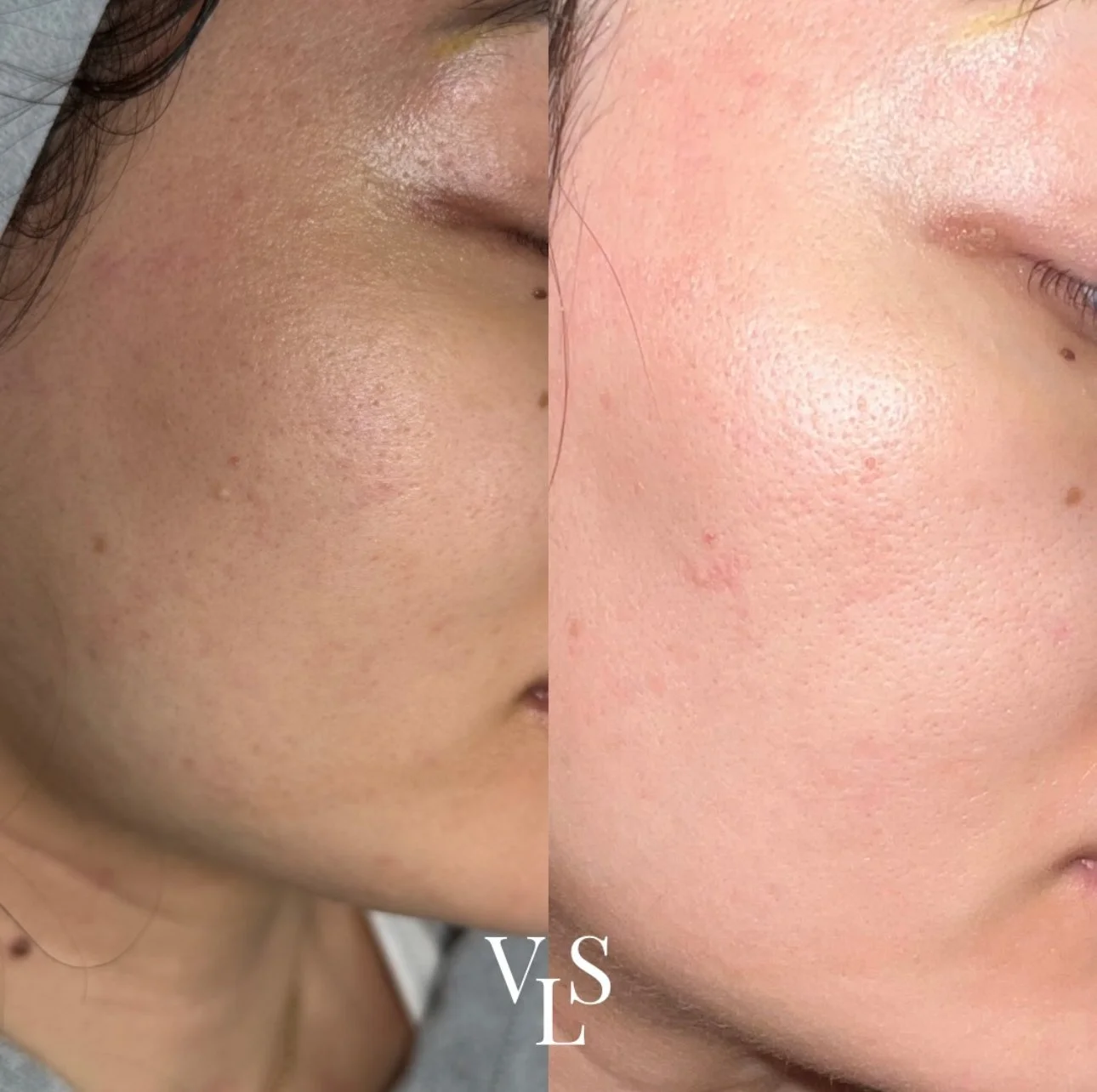 MICRONEEDLING BEFORE & AFTER