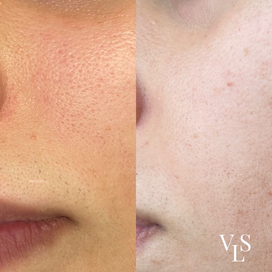 MICRONEEDLING BEFORE & AFTER