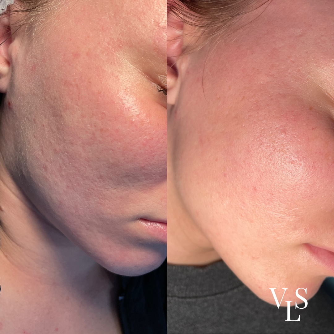 MICRONEEDLING BEFORE & AFTER