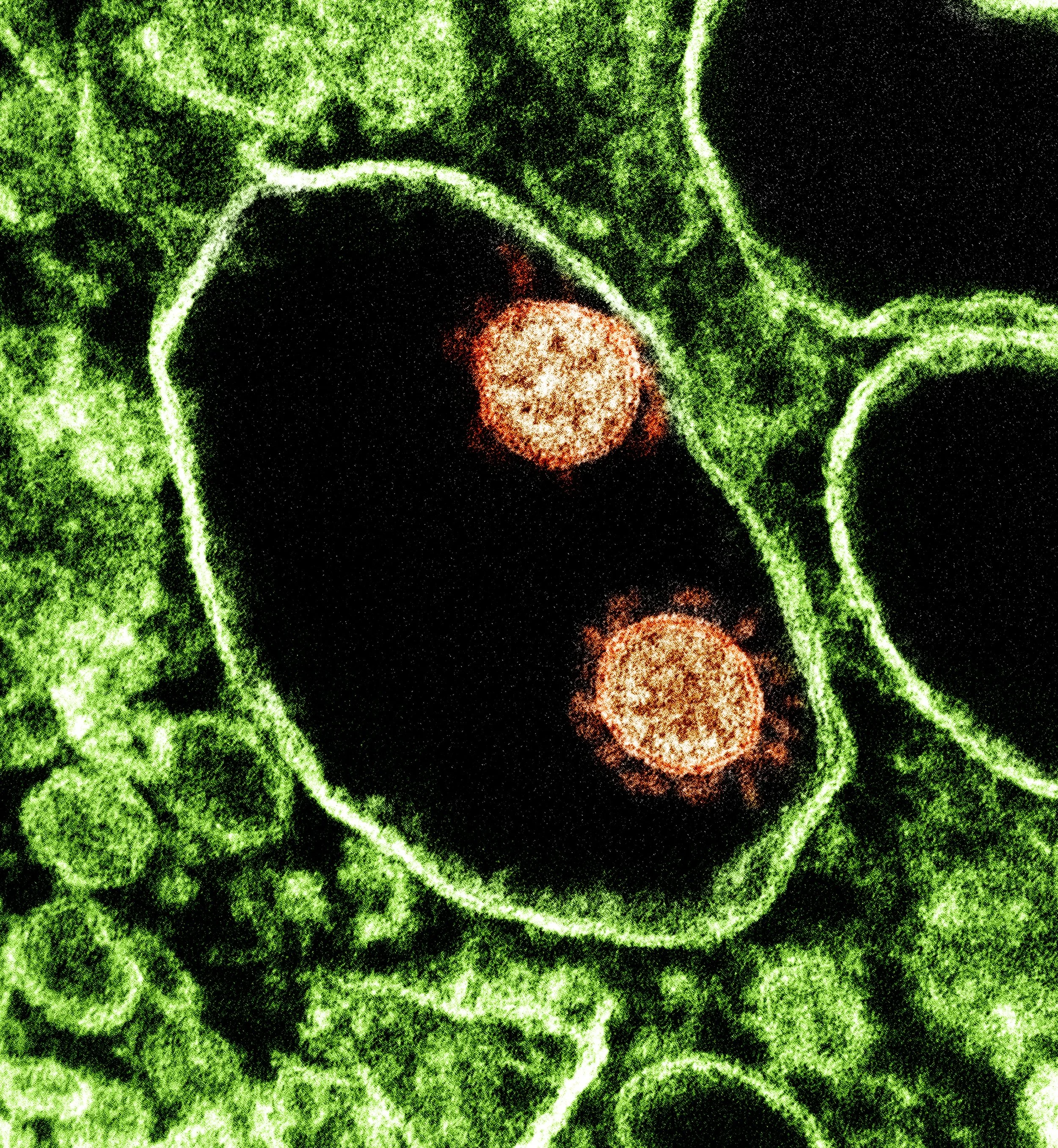 A colored, electron microscope image of two coronavirus particles surrounded by green cellular structures.