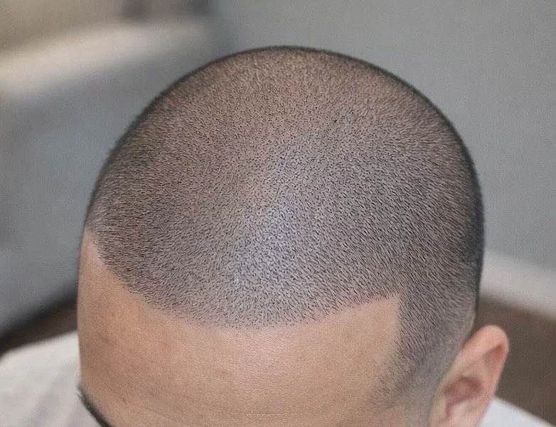 SMP Scalp Micropigmentation