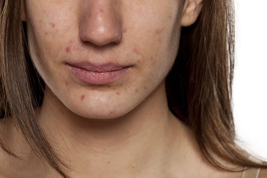 Treatment for Acne and Acne Scarring Brisbane.jpg