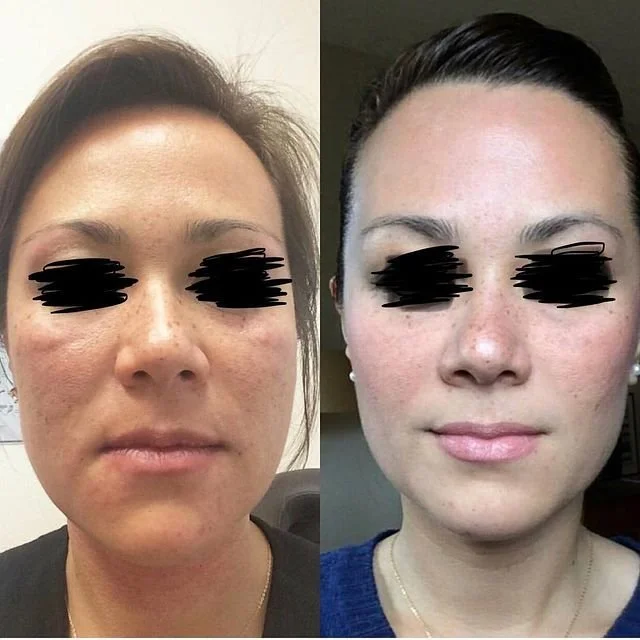 Side-by-side comparison of a woman's face before and after skincare or cosmetic treatment. The left shows her with uneven skin tone, redness, and acne scars. The right shows her with clearer, smoother skin, reduced redness, and a more even complexion.