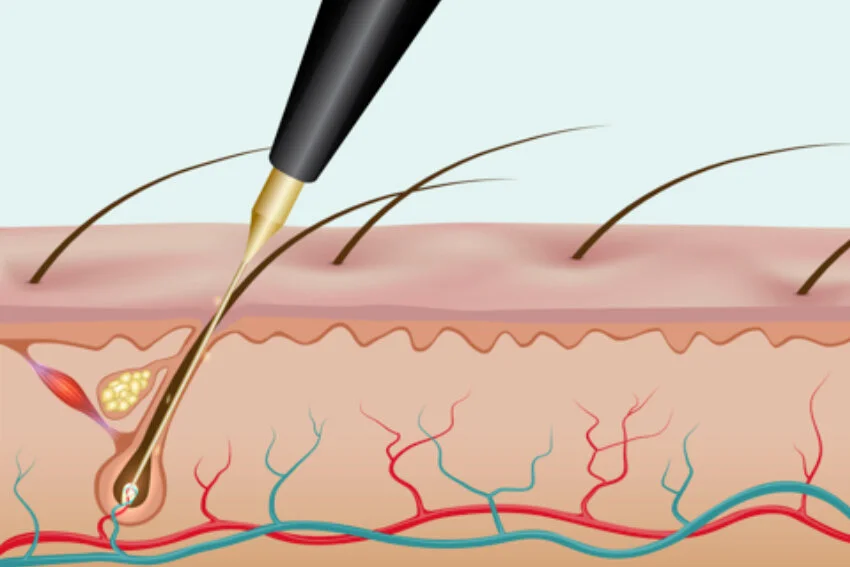 Electrolysis is still the only method of permanent hair removal.
