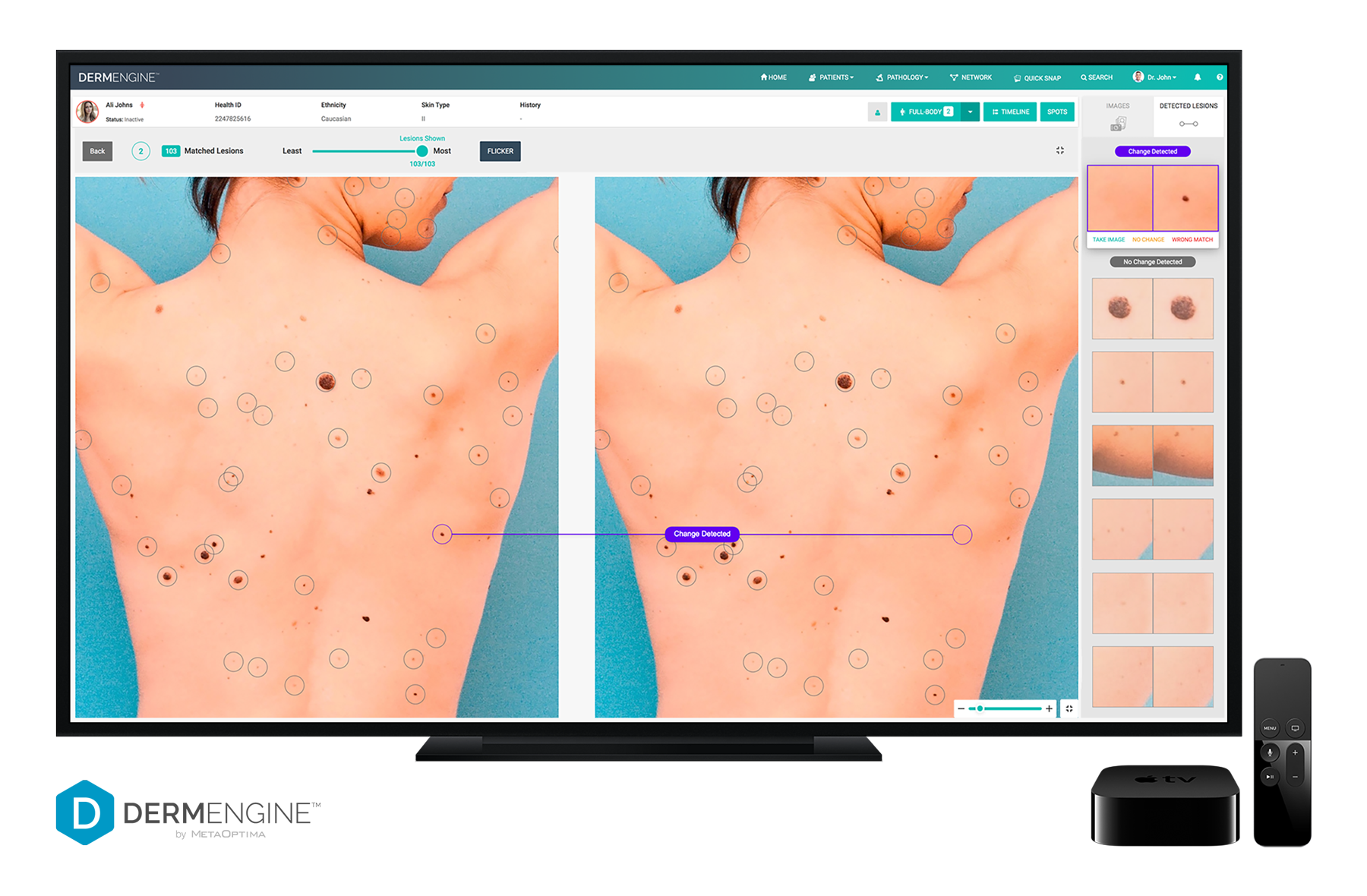 Computer screen displaying a dermatology application with multiple images of a person's back, showing skin lesions. The interface includes options to identify and track skin lesions over time, with highlighted areas and annotations.