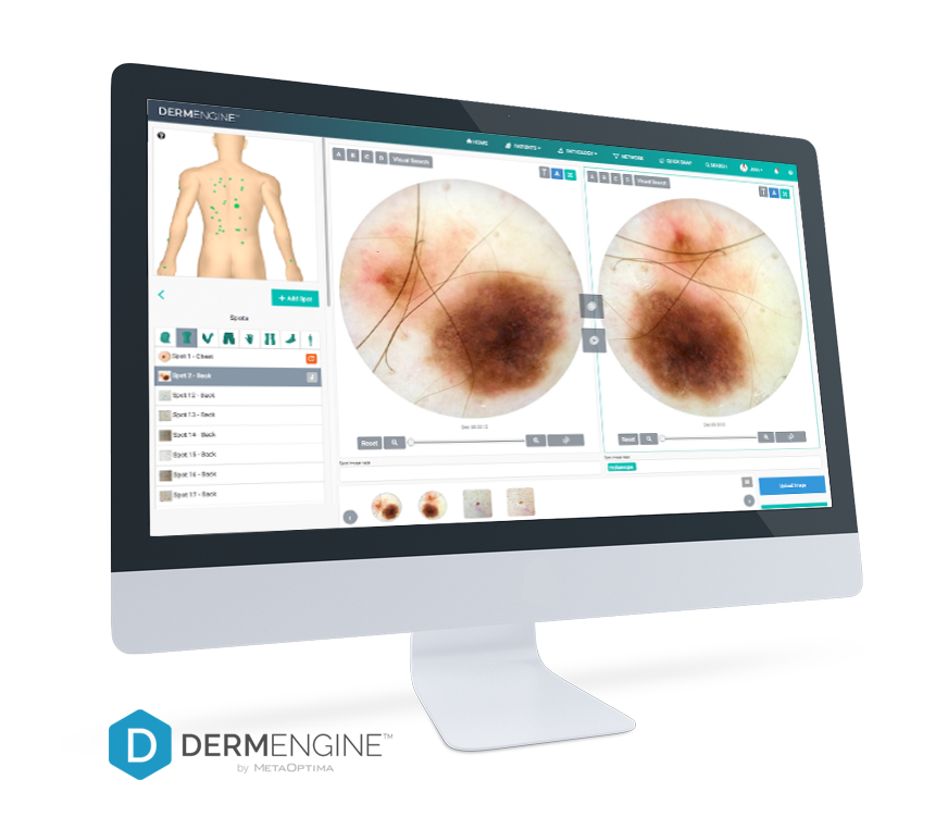 Computer screen displaying a medical imaging software with images of skin moles or lesions for diagnosis.