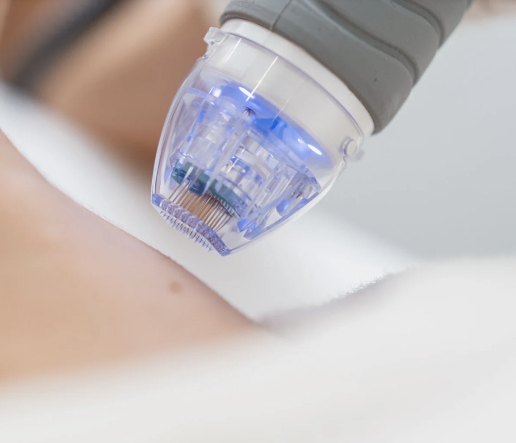 What is microneedling? 