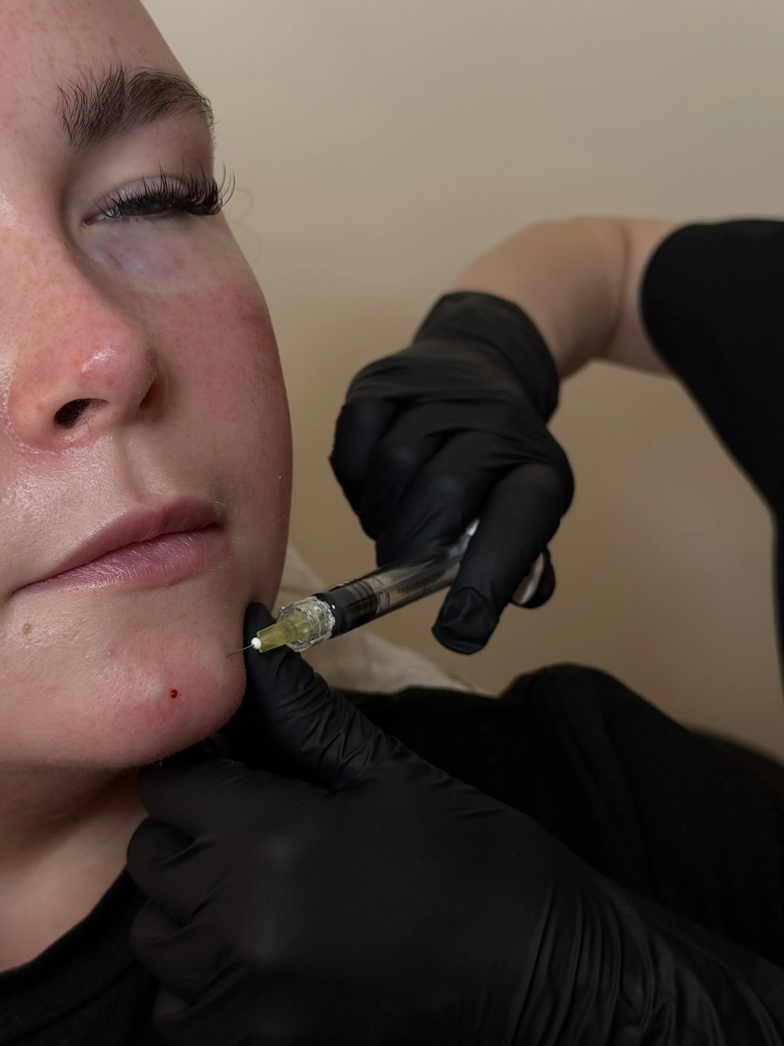 A person receiving a facial injection from a medical professional wearing black gloves. Polynucleartides